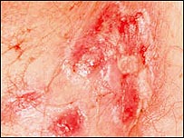 سلول سرطانی خون