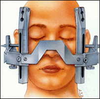Estimulação profunda do cérebro