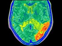 Cérebro com derrame