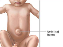 چره در کودکان