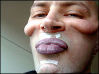 Prótese do artista Paddy Hartley