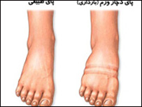 حاجيان، د پښو درد او پړسوب