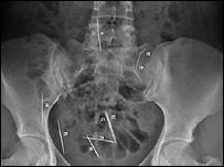 Radiografia cedida pelo Richland International Hospital 