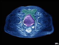 Exame de raio X revelando câncer de próstata
