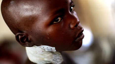 A Congolese boy recovers in a hospital in North Kivu