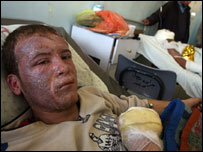 زخمی فلسطینی