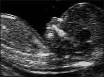 Ultra-sonografia de um feto 