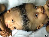 دونوں بھائیوں کا آپریشن اڑتالیس گھنٹے جار رہے گا۔