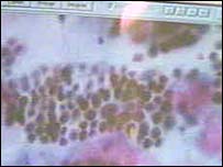 Papilomavírus humano