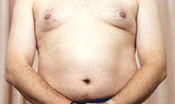 Hernia operations are common in men