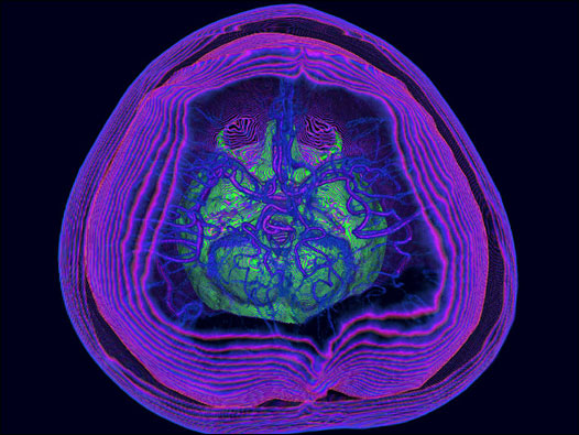Tomografia (Foto: Cortesia Dr. Kai-hung Fung)
