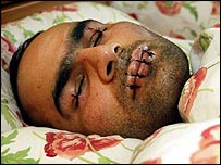 Sınırdışı planlarını protesto etmek için dudaklarını diken bir ilticacı