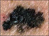 Melanoma