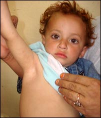 يوه ماشومه چې د شری په مرض اخته دی