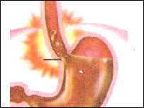 التهابی شدن مری و معده