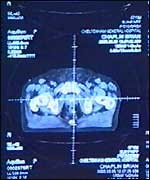 Scan of Brian's prostate