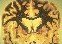 Section through the brain