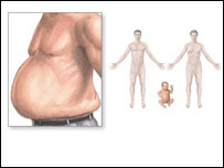 افزايش وزن در مرض شکر خطردارد