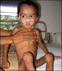 خوارځواکی ماشوم