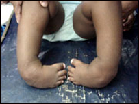 دماشوم دهډوکونرمښت