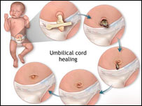 مراقبت از ناف نوزاد