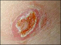  د کالدانې مخنيوی او درملنه