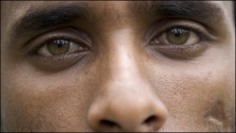 Survivor: Biadglign Befekadu still bears the scars of the famine to this day.