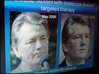 Фото 3 з доповіді професора: Віктор Ющенко після отруєння