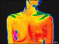 Câncer de mama (arquivo)