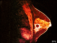 Kanserli bir göğüs