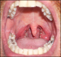  د تانسلونو مکروبي کېدل