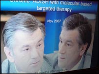 Фото 4 з доповіді професора: Віктор Ющенко після отруєння