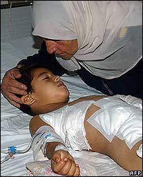 Trẻ em Li Băng bị thương vì bom bi 