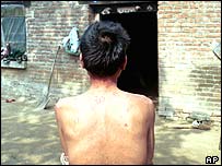 Pacient kinez i infektuar me HIV.