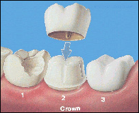 پوسيدگی دندان