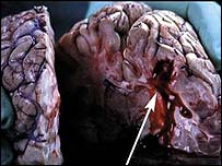 Mozek poškozený kouřením 