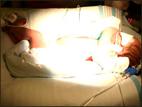 نوزاد مبتلابه زردی