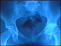 لگن خاصره در عکس راديولوژی