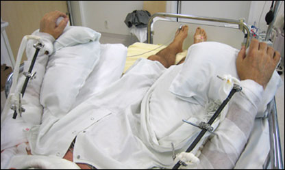 Paciente com braços transplantados (foto: Klinikum rechts der Isar)