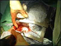 Criocirurgia em tumor de pulmão