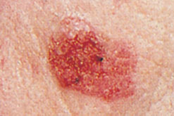 Image: Photograph shows a mole which has changed in size, shape and colour - the early warning signs of malignant melanoma
