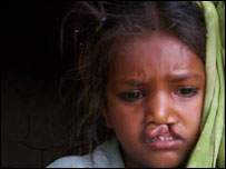  कटे होंठों वाली पिंकी