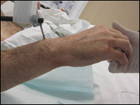 Braço transplantado (foto: Klinikum rechts der Isar)