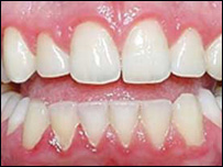  د وريو پړسوب او وينې کېدل