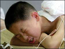 一个在接受中医治疗的孩子