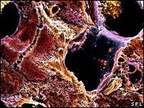 Células do fígado com cirrose