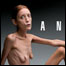 Foto da campanha 'No Anorexia' (foto: Oliviero Toscani)