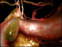 سنگ کيسه صفرا