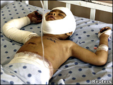 طفل أفغاني مصاب بهجوم