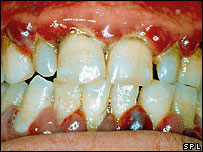 Infecção na gengiva